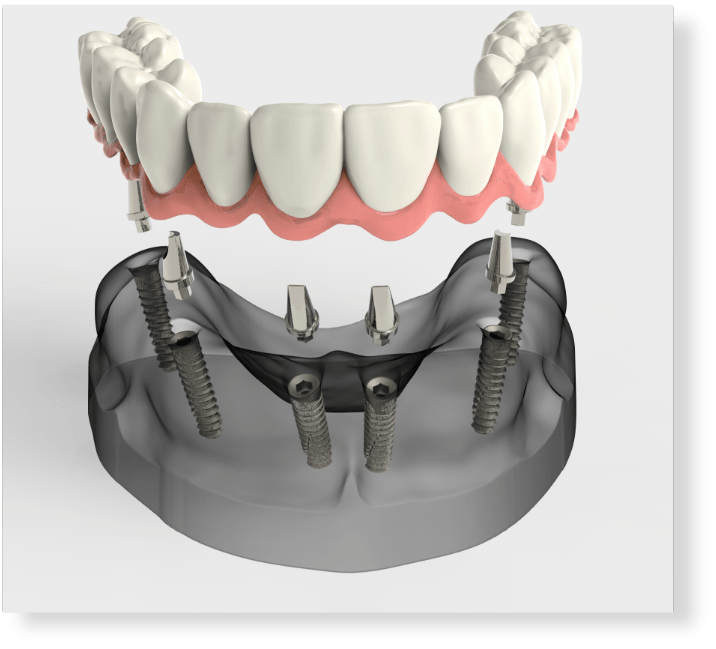 Implantologia | Dentista Novelli